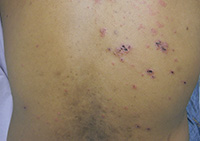 Primary varicella